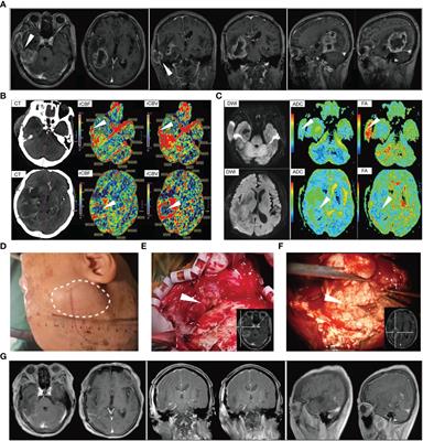 Frontiers Rapid Progression Of Subcutaneous Glioblastoma A Case